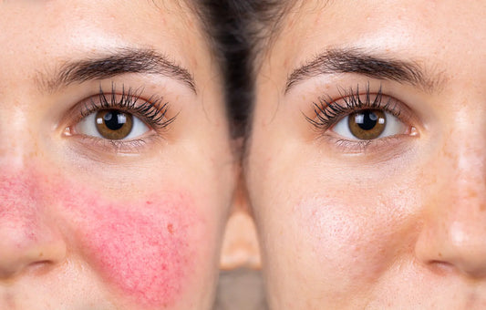 side by side comparison of sensitive skin reaction next to same face but skin restored and no longer inflamed